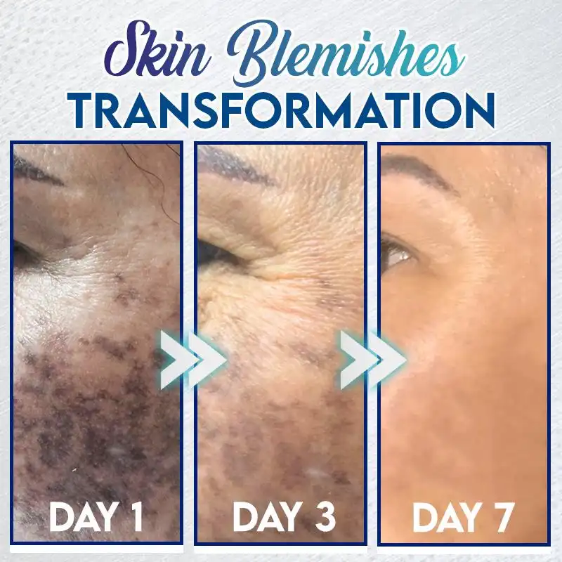 Żel do natychmiastowego usuwania przebarwień - obrazek 2